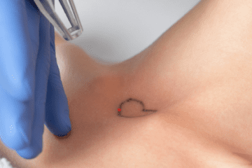Top Reasons to Choose Saline Tattoo Removal Over Laser Removal